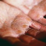 3 Tips For Managing Eczema
