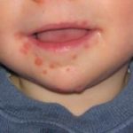 Hand, Foot and Mouth Disease