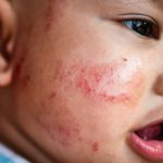 Baby acne – causes, symptoms and what to do about it