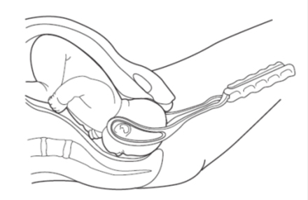Forceps