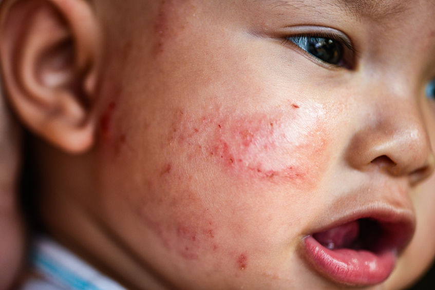 Baby acne – causes, symptoms and what to do about it